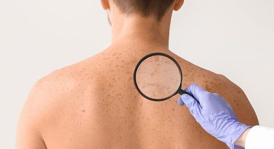 04-12-2023_Omint_BLOG-Cancer-de-Pele_1440x403